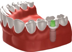 Zahnarztpraxis Dr. Julia Plomin: Implantatgetragene ProtheseEinzelzahnimplantat im Seitenzahnbereich