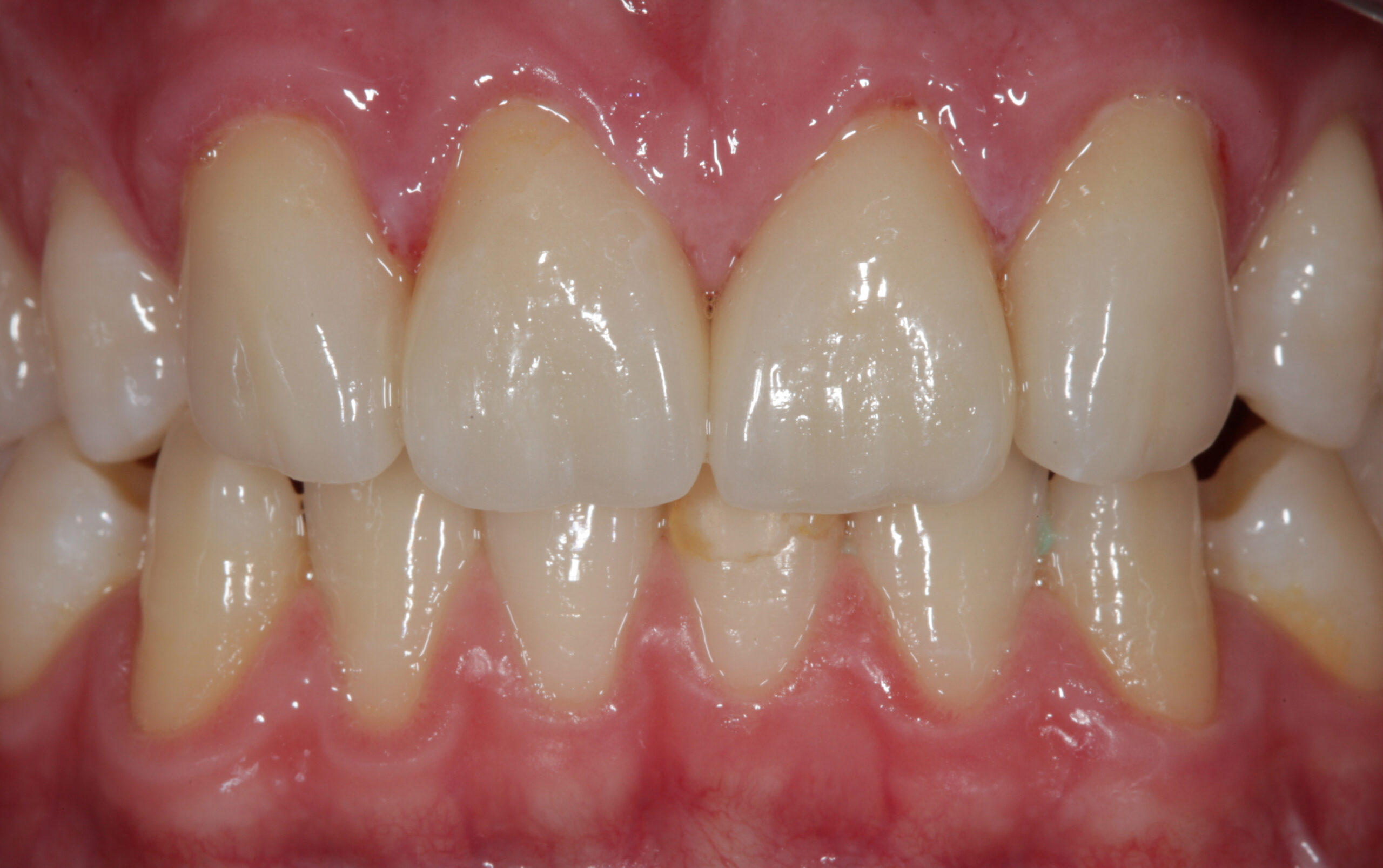 Zahnarztpraxis Dr. Julia Plomin: Ästhetische Zahnheilkunde - nachher. Foto: (c) Hipp Dentaltechnik Weingarten