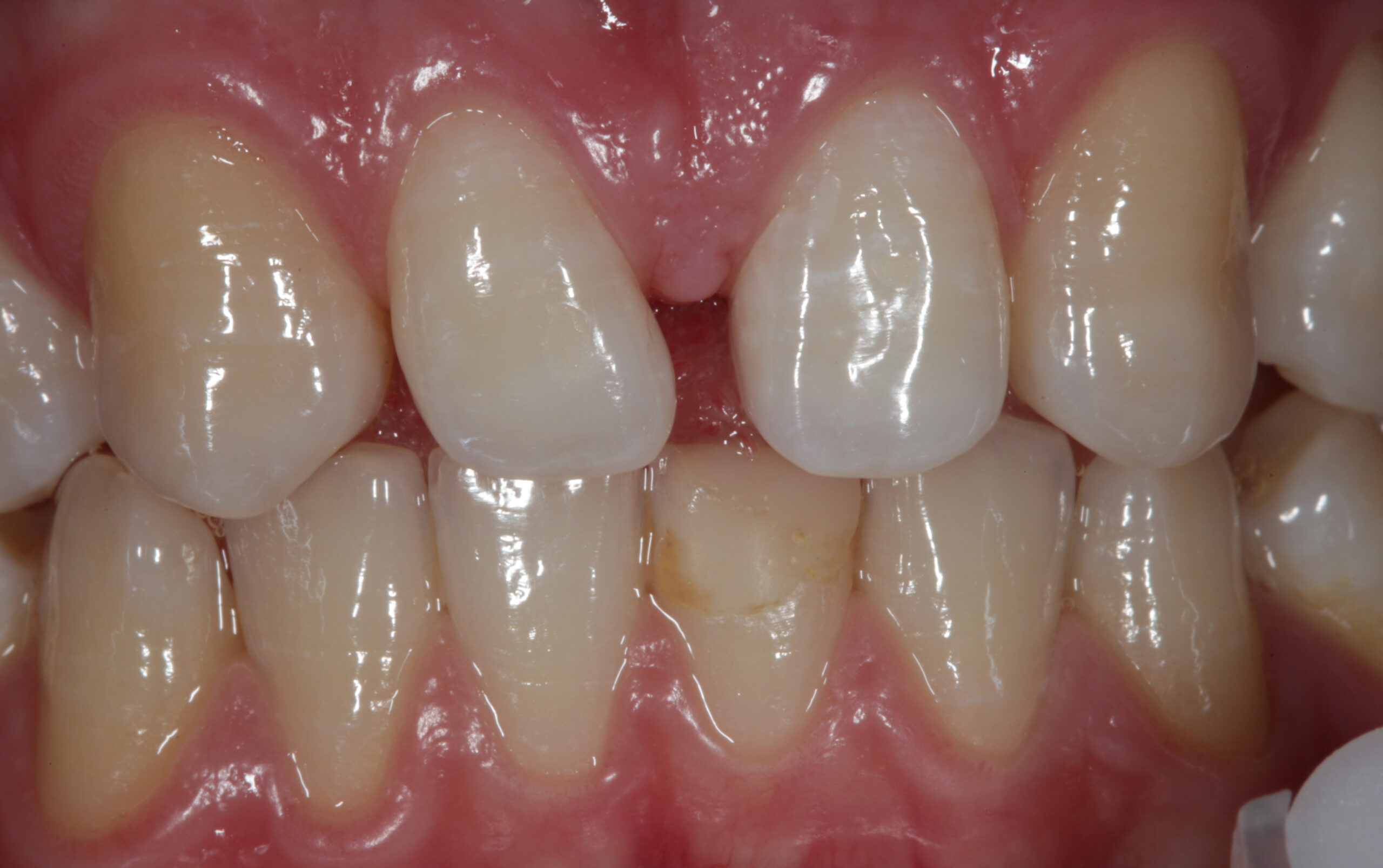 Zahnarztpraxis Dr. Julia Plomin: Ästhetische Zahnheilkunde - vorher. Foto: (c) Hipp Dentaltechnik Weingarten